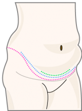 Roze stippelllijn : hoge spanning abdominoplastie