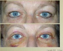 Plastische chirurgie - ooglidcorrectie